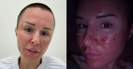 Przypalona Blanka Lipińska prezentuje lico po laserze. "Spodziewałam się koszmaru, a tu MIŁA NIESPODZIANKA" (FOTO)