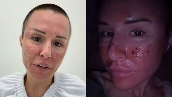 Przypalona Blanka Lipińska prezentuje lico po laserze. "Spodziewałam się koszmaru, a tu MIŁA NIESPODZIANKA" (FOTO)