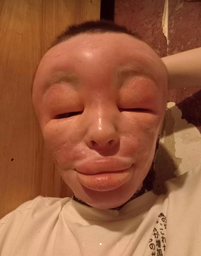 Elva przed operacją