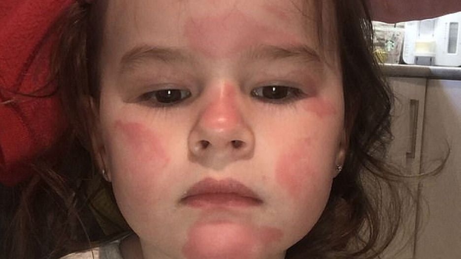 Posmarowała córkę balsamem. Po kilku sekundach trzylatka zaczęła krzyczeć