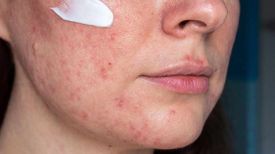 Ryzyko schizofrenii dzięki doksycylinie spada nawet o 35 procent.