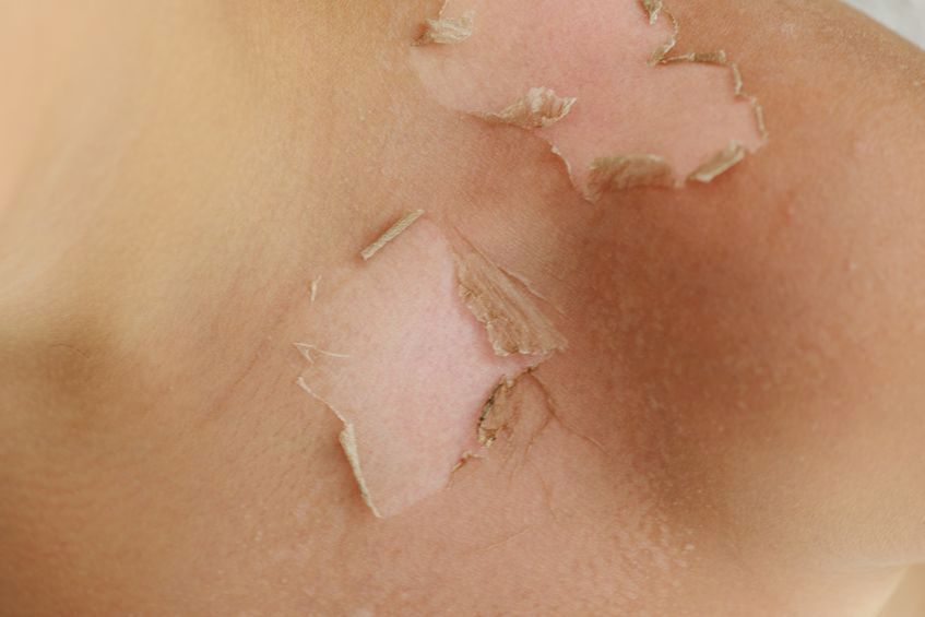 Profilaktyka czerniaka