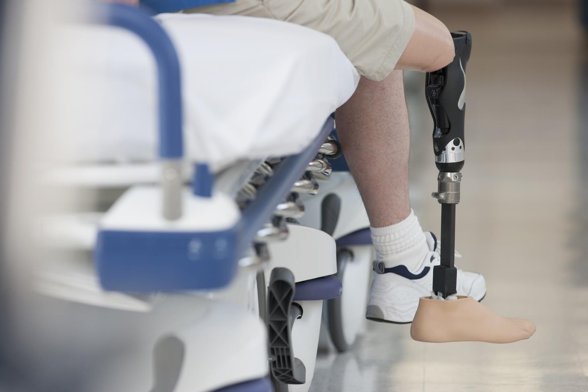 W Polsce wykonuje się tysiące amputacji rocznie