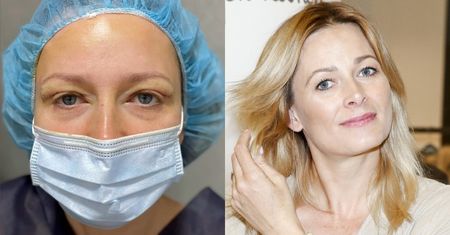 Odeta Moro miała plastykę powiek. Pokazała efekty: "10 lat mniej w 10 dni" (FOTO)