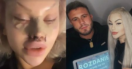 Nieustraszona Ewel0na zdradza, jakim zabiegom poddała się w Turcji...