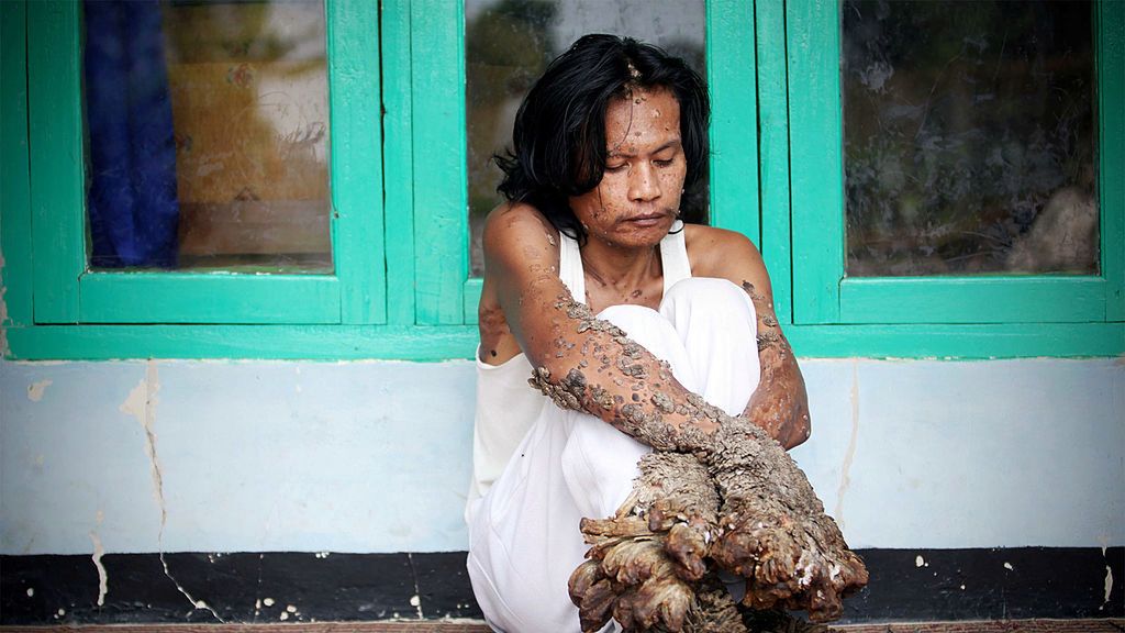 Przez narośle na jego ciele znajomi odwrócili się od DeDe