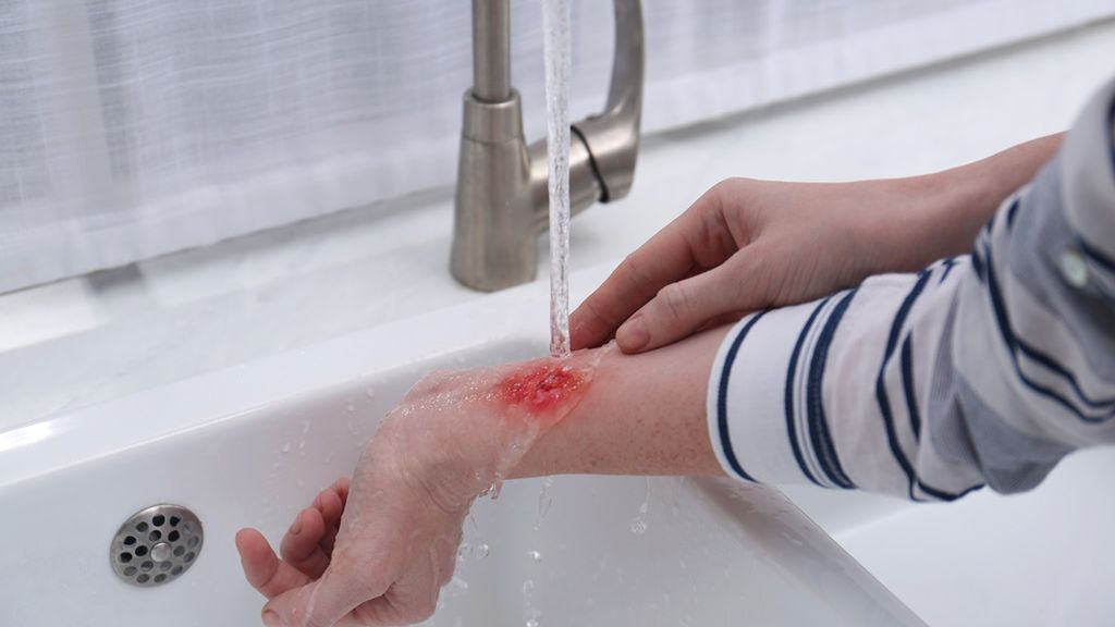 Po oparzeniu należy co najmniej 15 minut schładzać ranę chłodną wodą