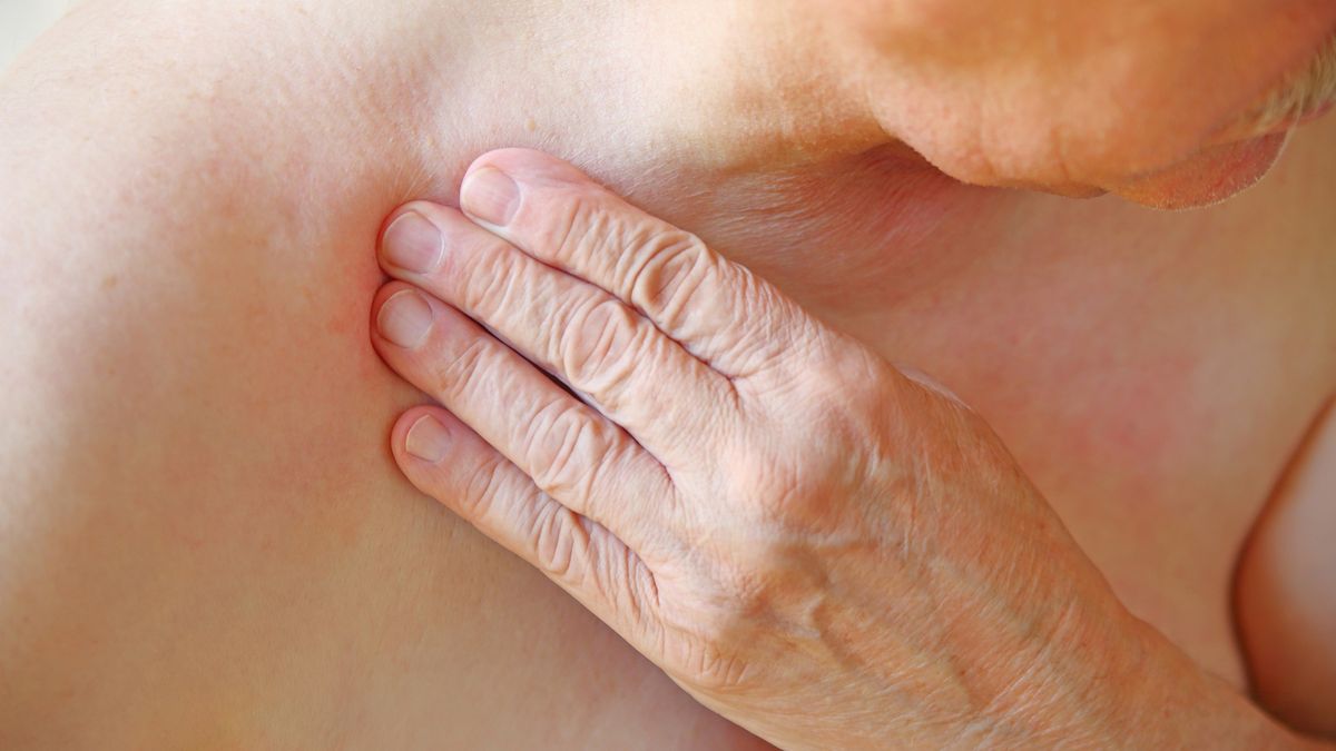 Objawy raka na skórze