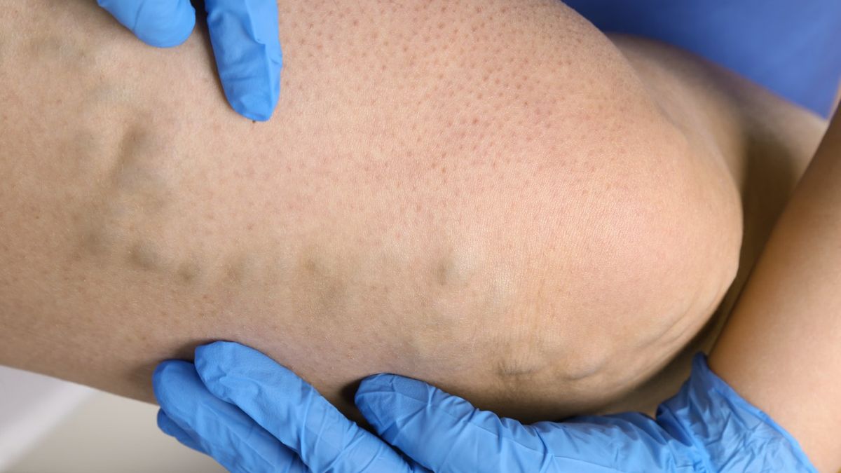 Skleroterapia to nieoperacyjna metoda leczenia żylaków, zarówno kończyn dolnych, jak i o odbytu.