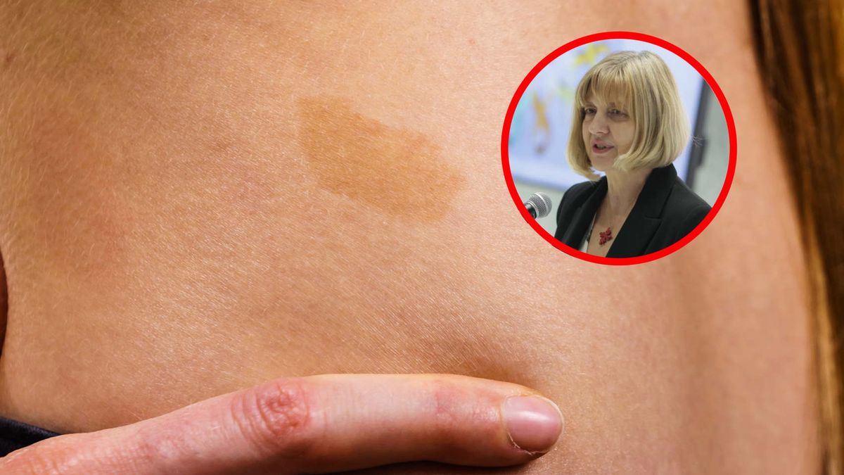 Choroba, która deformuje ciało. Objawem mogą być kawowe plamki