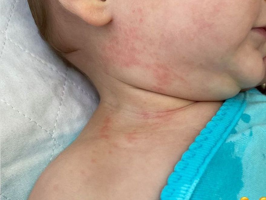 Wysypka "covidowa" może wystąpić na różnych częściach ciała