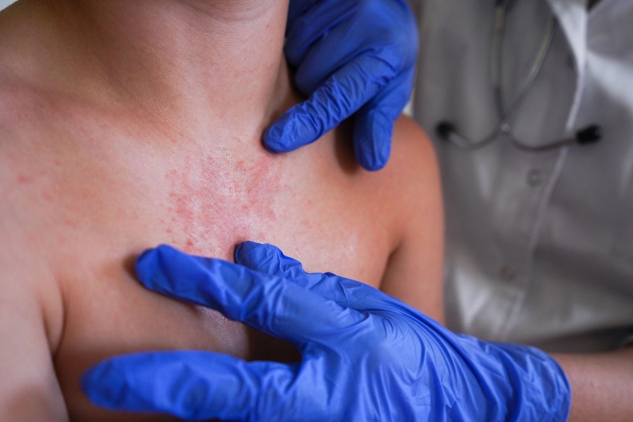 34 tys. zakażeń na odrę. WHO: Szczepionka chroni na całe życie