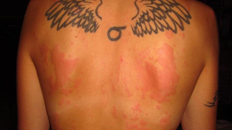 Czerwone plamy na skórze mogą być objawem wielu schorzeń