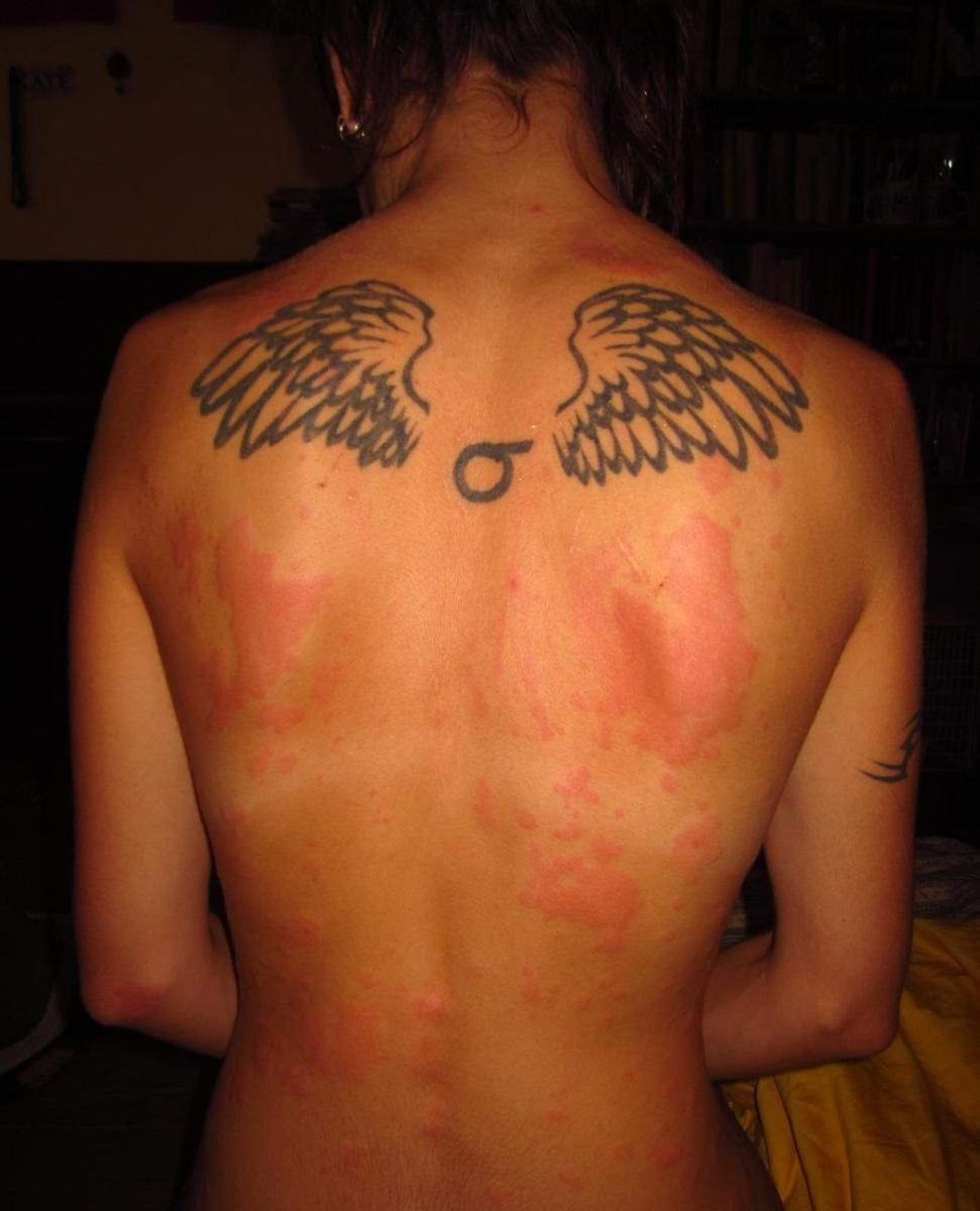 Mogą być czerwone, brązowe lub żółte. Sprawdź, co oznaczają plamy na skórze