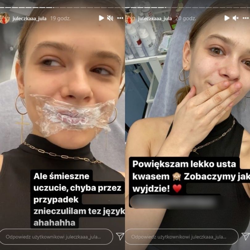 Julia Wróblewska powiększyła usta kwasem hialuronowym