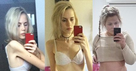 17-letnia anorektyczka NIE JADŁA PRZEZ TYDZIEŃ, żeby... "zdobyć popularność w szkole"!