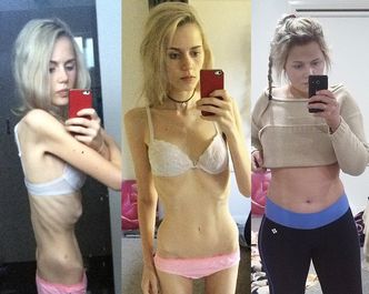 17-letnia anorektyczka NIE JADŁA PRZEZ TYDZIEŃ, żeby... "zdobyć popularność w szkole"!