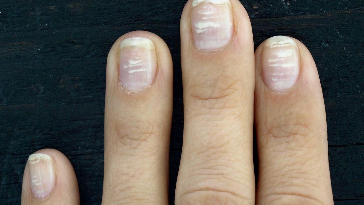 Białe plamki na paznokciach