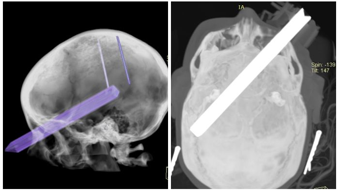 Wynik badania TK Zofii Zwolińskiej w dniu wypadku 