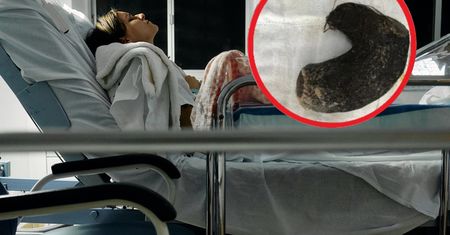 Rodzice nic nie wiedzieli o nawyku nastolatki. Oto co wyciągnęli z brzucha 13-latki