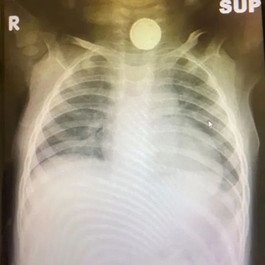 Bateria w przełyku Sofii