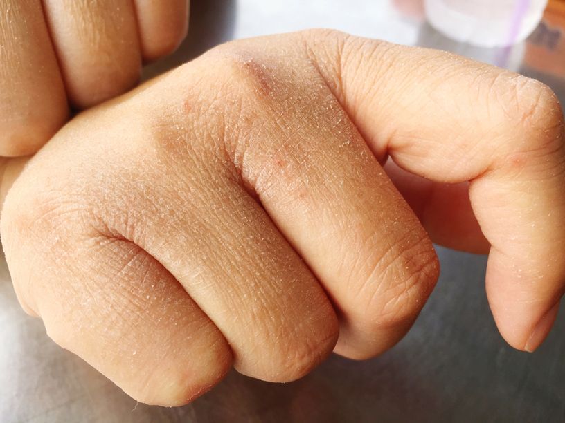 O chorej wątrobie może świadczyć m.in. bardzo sucha skóra