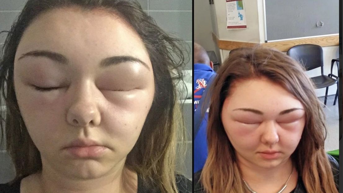 Alergia na farbę do włosów może powodować opuchliznę twarzy, obrzęk głowy, czasową utratę wzroku i duszności