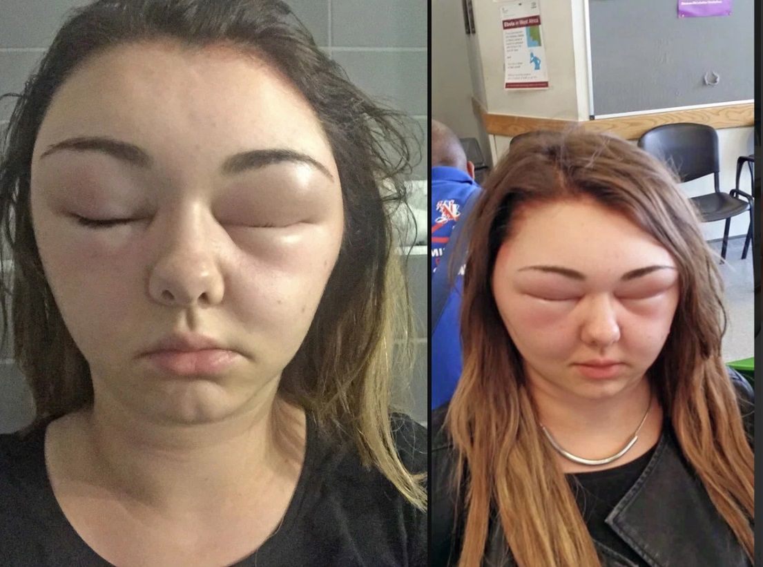 Alergia na farbę do włosów. Kobieta prawie oślepła