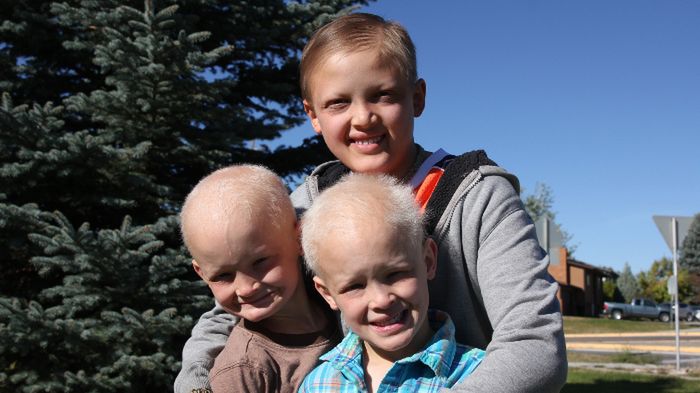 Odnaleźć się w chorobie: hipohydrotyczna dysplazja ektodermalna