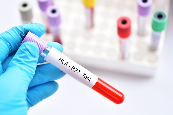 HLA-B27 to antygen, który może być związany z kilkoma chorobami autoimmunologicznymi.