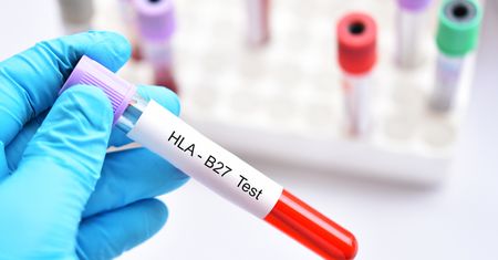 HLA-B27 - charakterystyka, wskazania do wykonania badania, choroby związane z HLA-B27