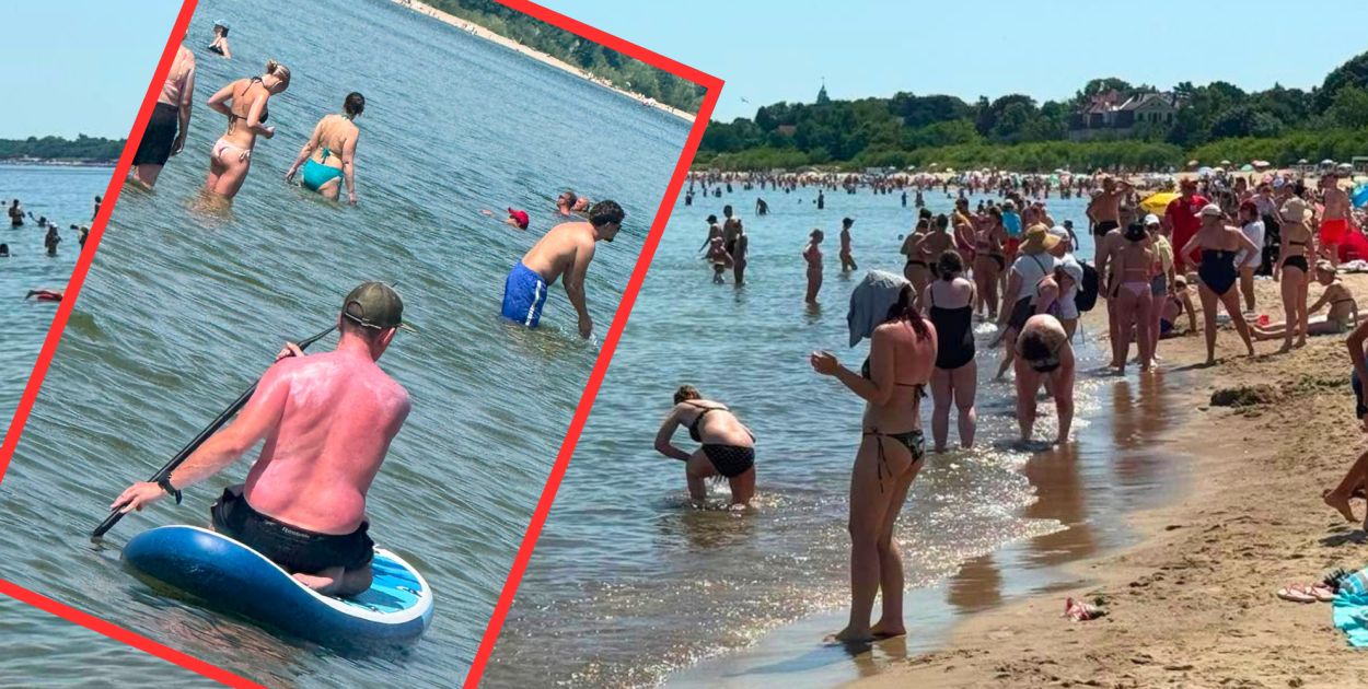 Sopot: mężczyzna z mocno poparzonymi plecami — zdjęcie hitem sieci