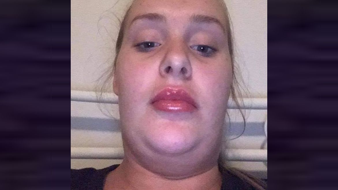 Jazmyn Forrest przed operacjami