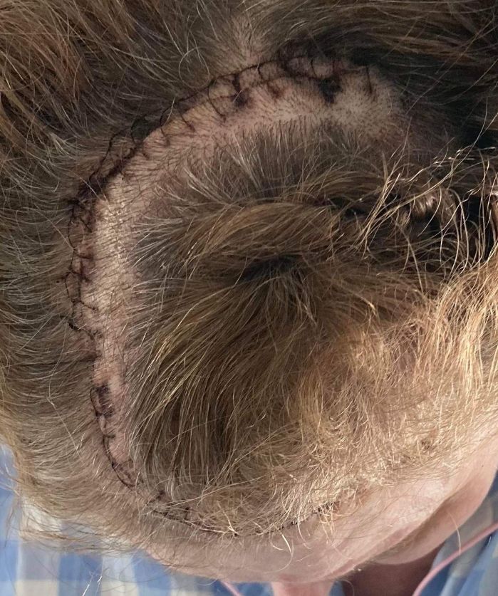 Kobieta przeszła operację usunięcia oponiaka