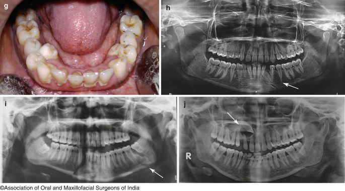 Problemy z zębami u dzieci są coraz częstsze