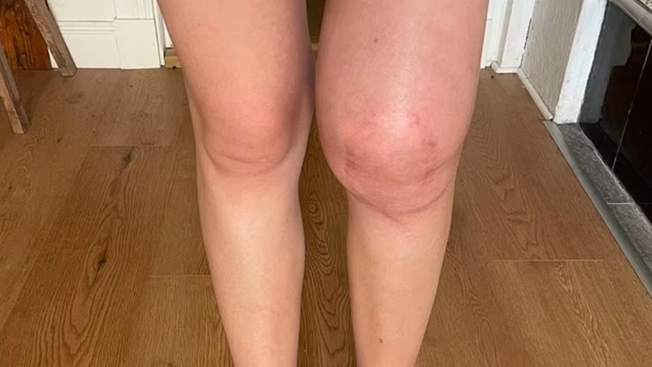 Alicia Ortstad poczuła ból w lewym kolanie. Tak objawiał się nowotwór