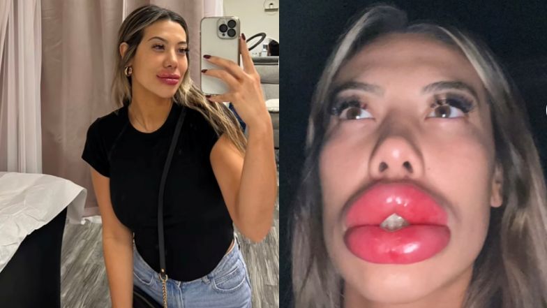 Amerykanka pokazała reakcję alergiczną na preparat, który wstrzyknęła sobie w usta