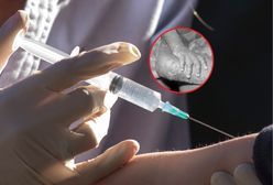 Małpia ospa. Niemcy będą się szczepić?