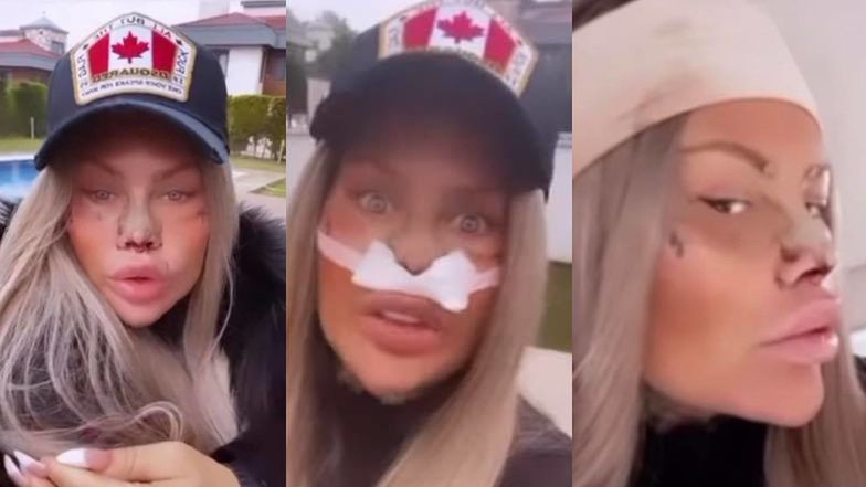 "Królowe Życia". Laluna Unique chwali się schodzącą opuchlizną po operacji