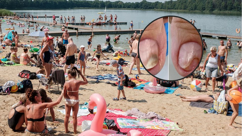 Pałeczka ropy błękitnej w polskich jeziorach. Zarażenie bakterią charakteryzuje się wieloma objawami m.in. uszkodzeniem płytki paznokcia