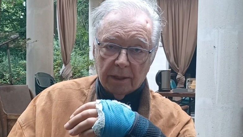 Krzysztof Zanussi pokazał obrażenia po wypadku na planie