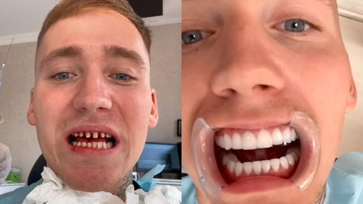 Zafundował sobie "turecką metamorfozę". Tak teraz wygląda