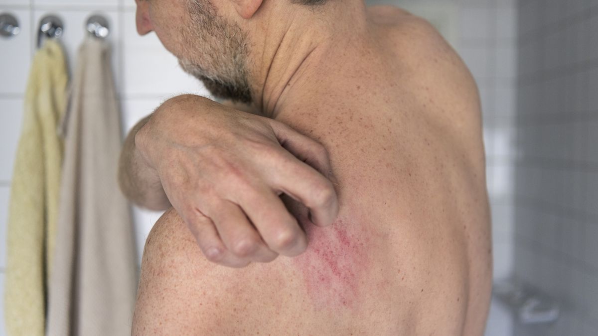 Łuszczycowe zapalenie stawów to przewlekła choroba zapalna 