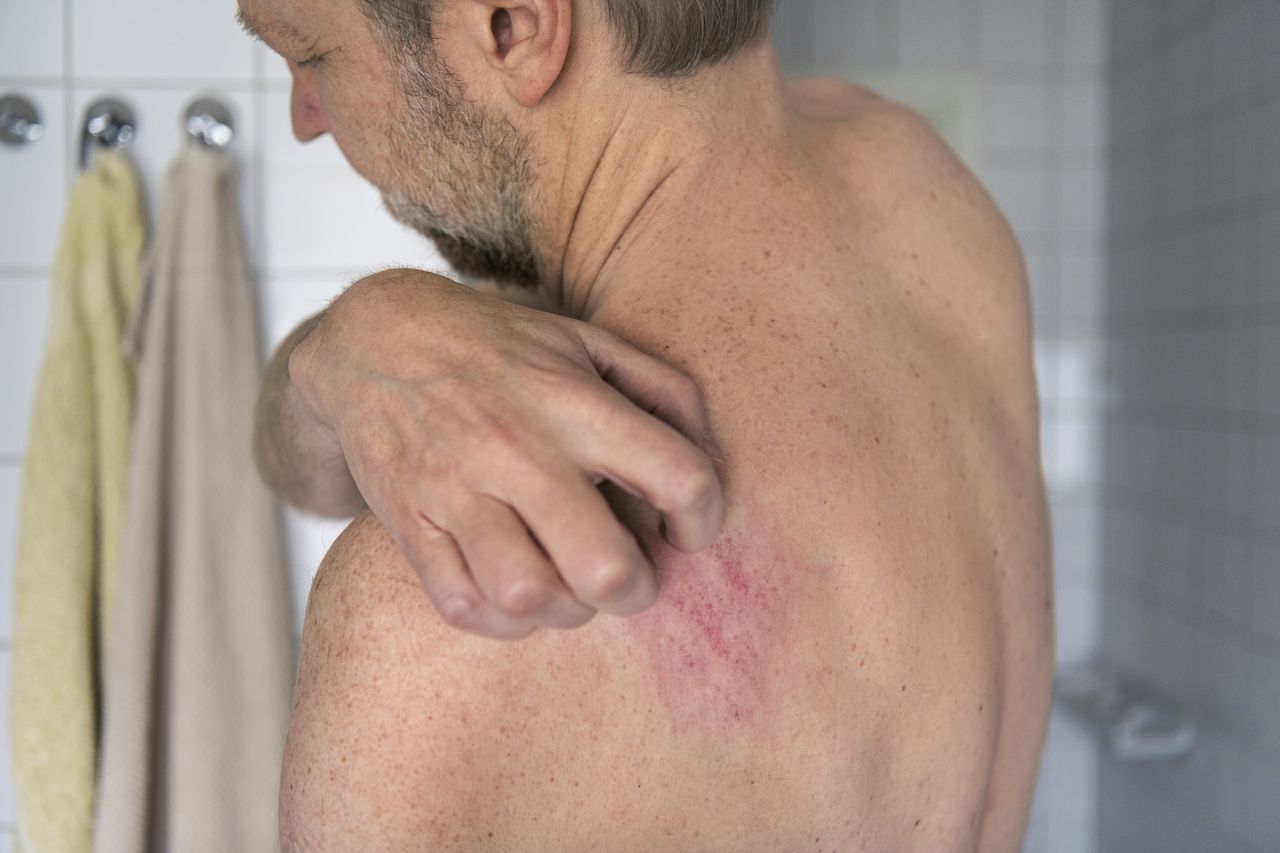 Pierwsza taka terapia. FDA zatwierdziła przełomowy lek na łuszczycowe zapalenie stawów