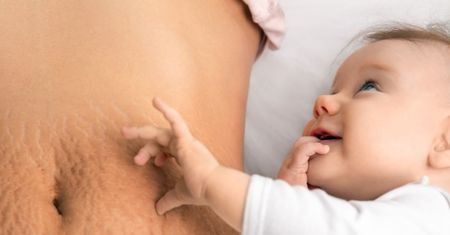 Rozstępy - charakterystyka, przyczyny, jak je usunąć, domowe sposoby na rozstępy