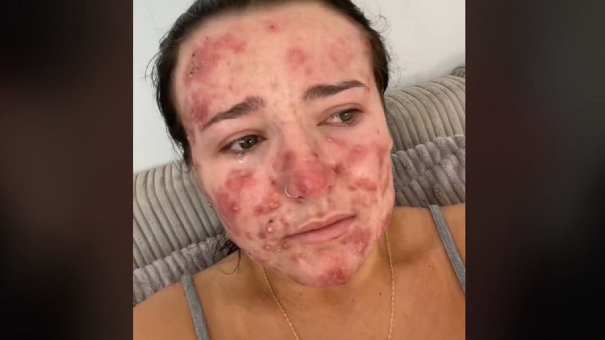 Walczy z potwornym trądzikiem. Jedna rzecz jej pomaga