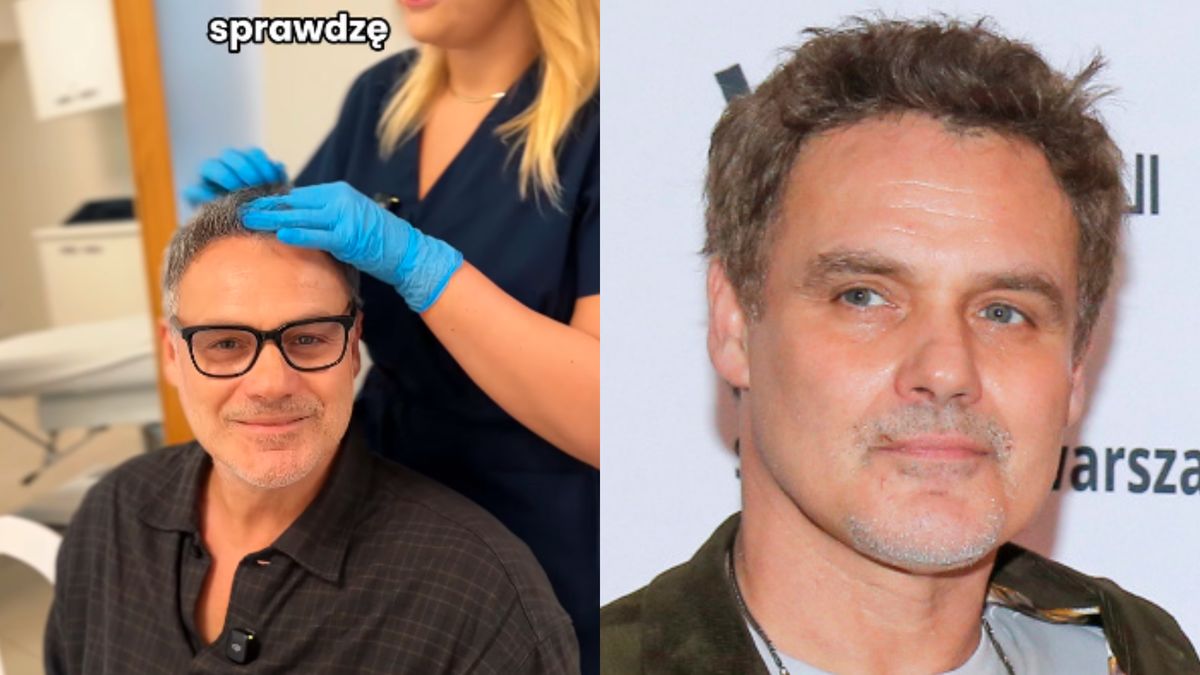 Jan Wieczorkowski przeszczepił włosy. Oto efekty