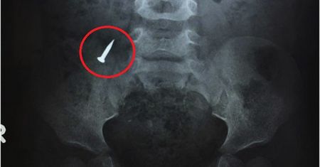 Czterolatek połknął gwóźdź. Chłopiec musiał przejść operację