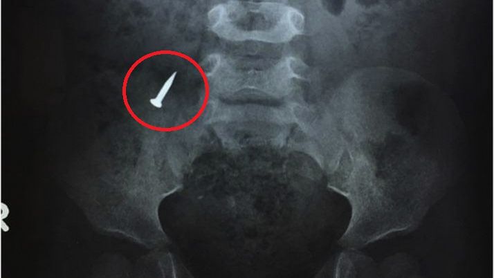 Czterolatek połknął gwóźdź. Chłopiec musiał przejść operację