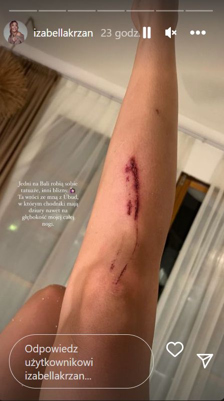 Izabella Krzan zraniła się w Ubud